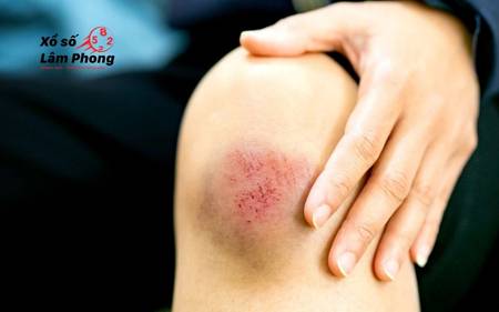 Giấc mơ té xe máy chảy máu là dấu hiệu về tổn thương, cả thể chất và tinh thần