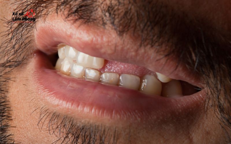 nằm mơ thấy rụng răng hàm trên