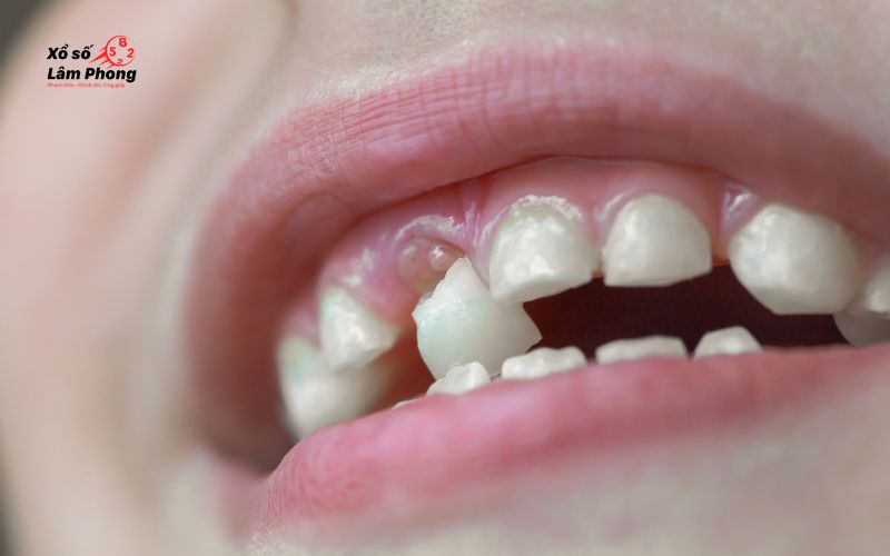 nằm mơ thấy rụng răng hàm trên