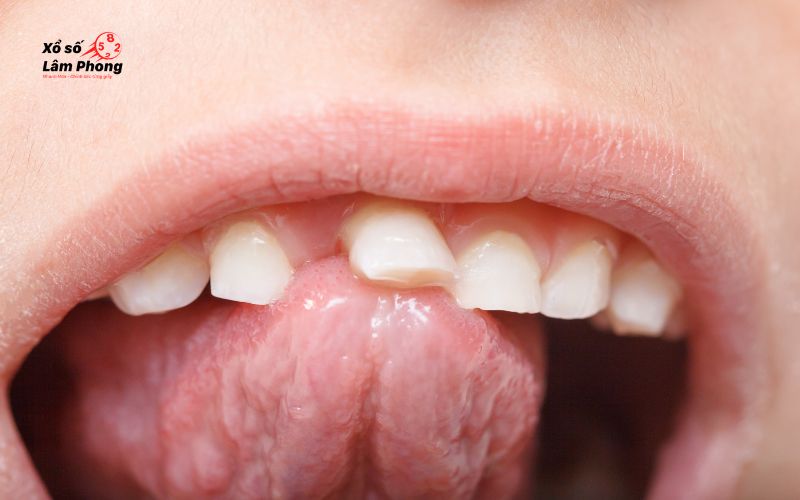 nằm mơ thấy rụng răng hàm trên