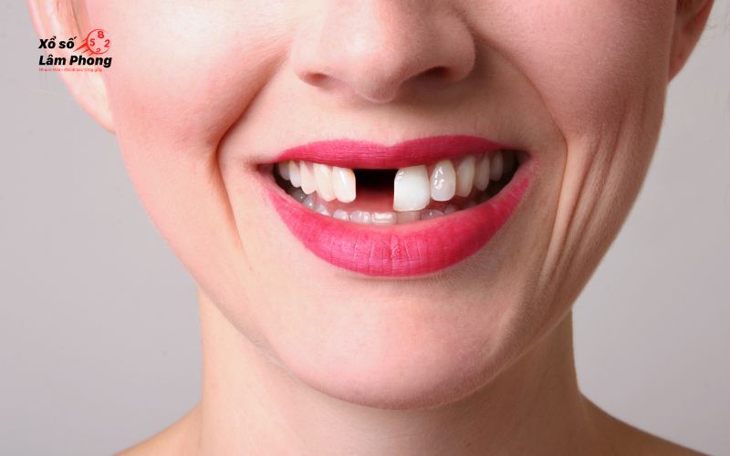 Nằm mơ thấy rụng răng hàm trên là điềm gì? Giải mã các bí ẩn