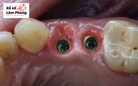 Mơ thấy răng sâu hàm dưới rụng nhưng không chảy máu