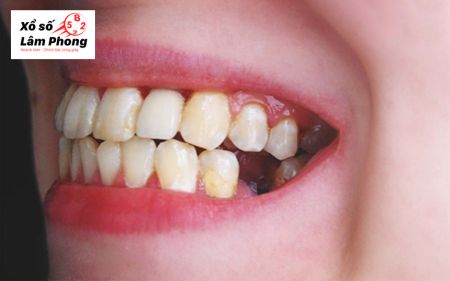 Những con số vàng ứng với các trường hợp nằm mơ thấy rụng răng hàm dưới không chảy máu